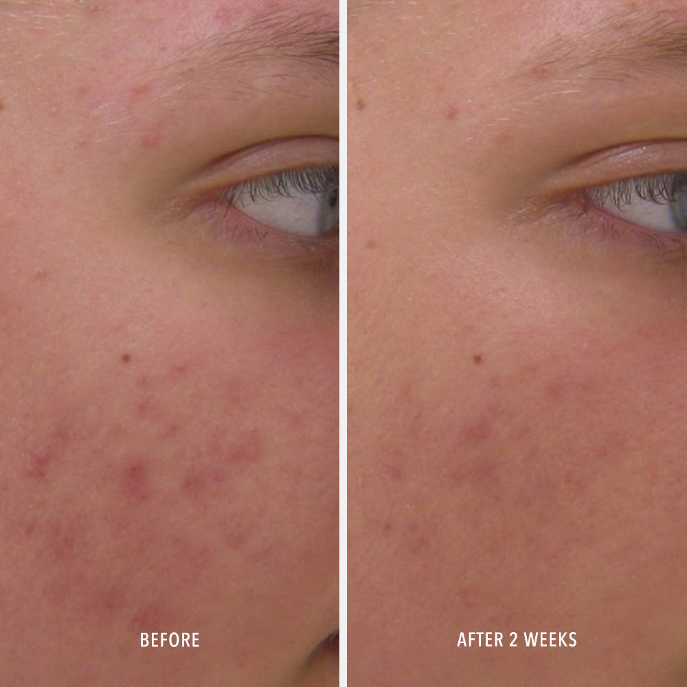 HydroPeptide Clear Rescue Peptide Acne Serum 30ml – view 3