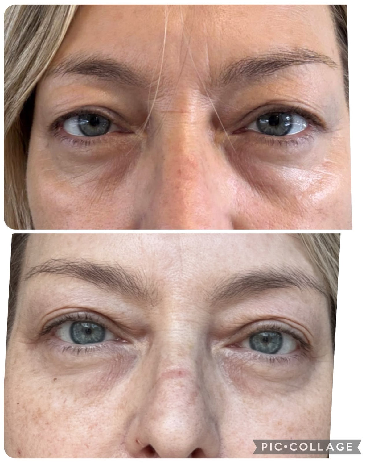 Before and after treatment at SkinVital Clinic
