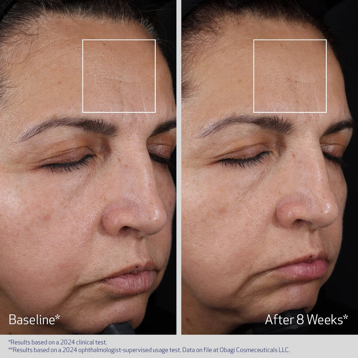 Obagi ELASTIderm® Advanced Filler Concentrate 20ml – before and after 1