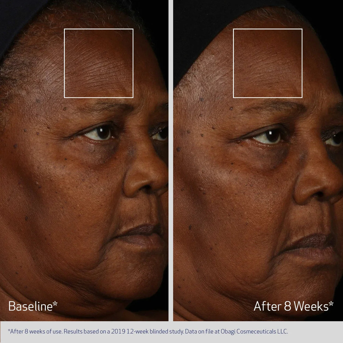 Obagi ELASTIderm® Facial Serum 30ml – before and after 1