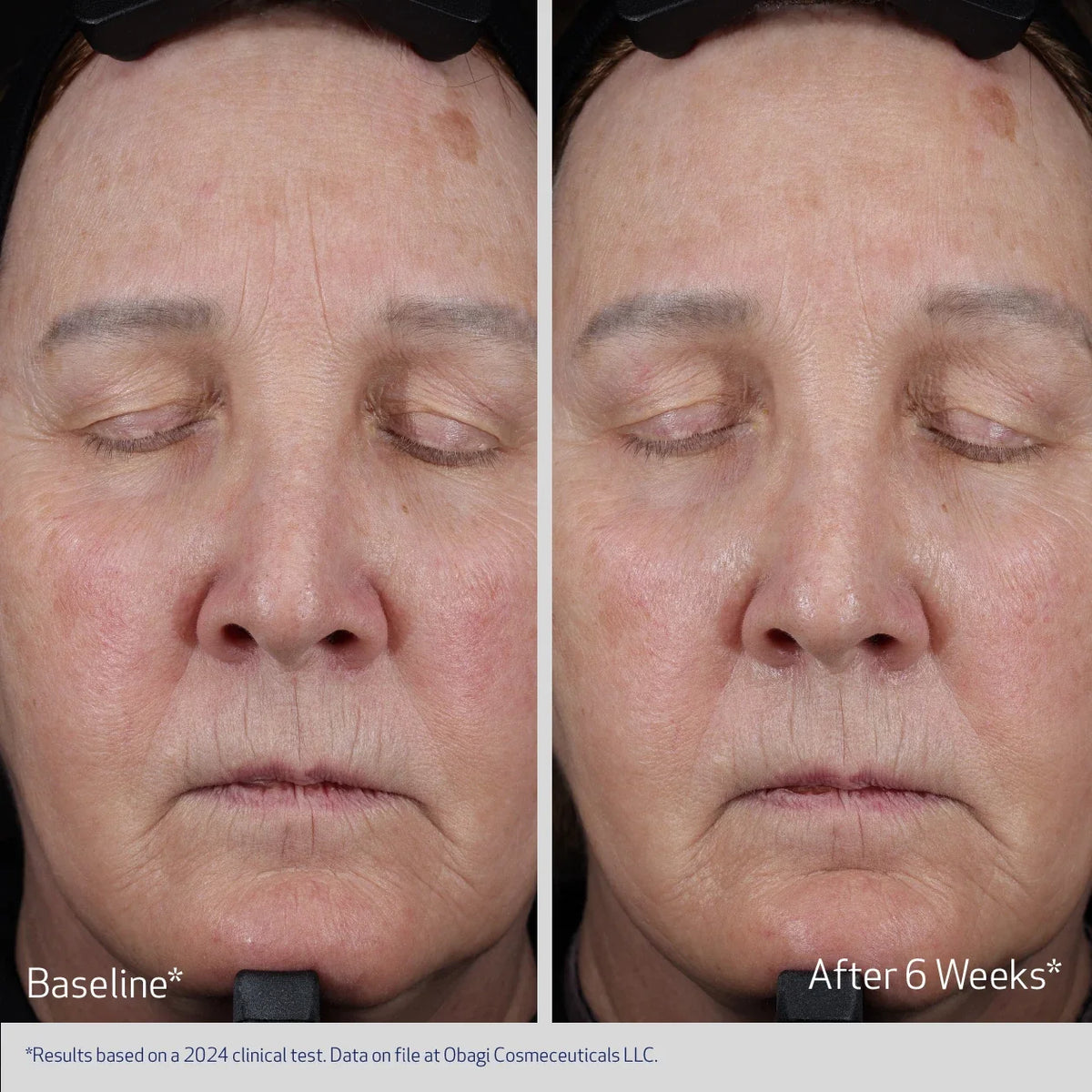 Obagi ELASTIderm® Sculpt & Eye Kit – before and after