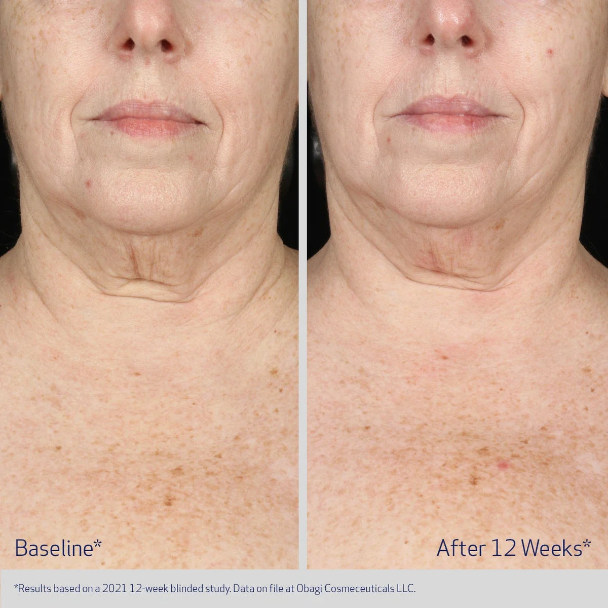Obagi ELASTIderm® Neck & Décolleté Concentrate 60ml – before and after 1