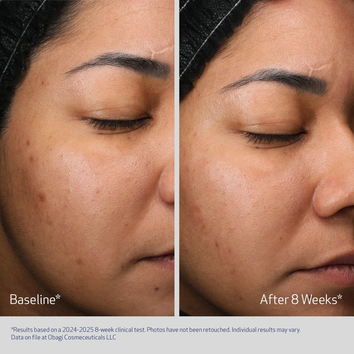 Obagi Retinol + PHA Refining Night Cream 50ml – before and after 1