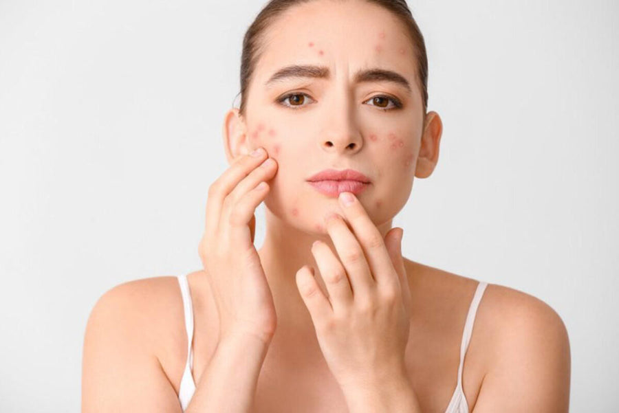 Acne Treatments at SkinVitál Clinic