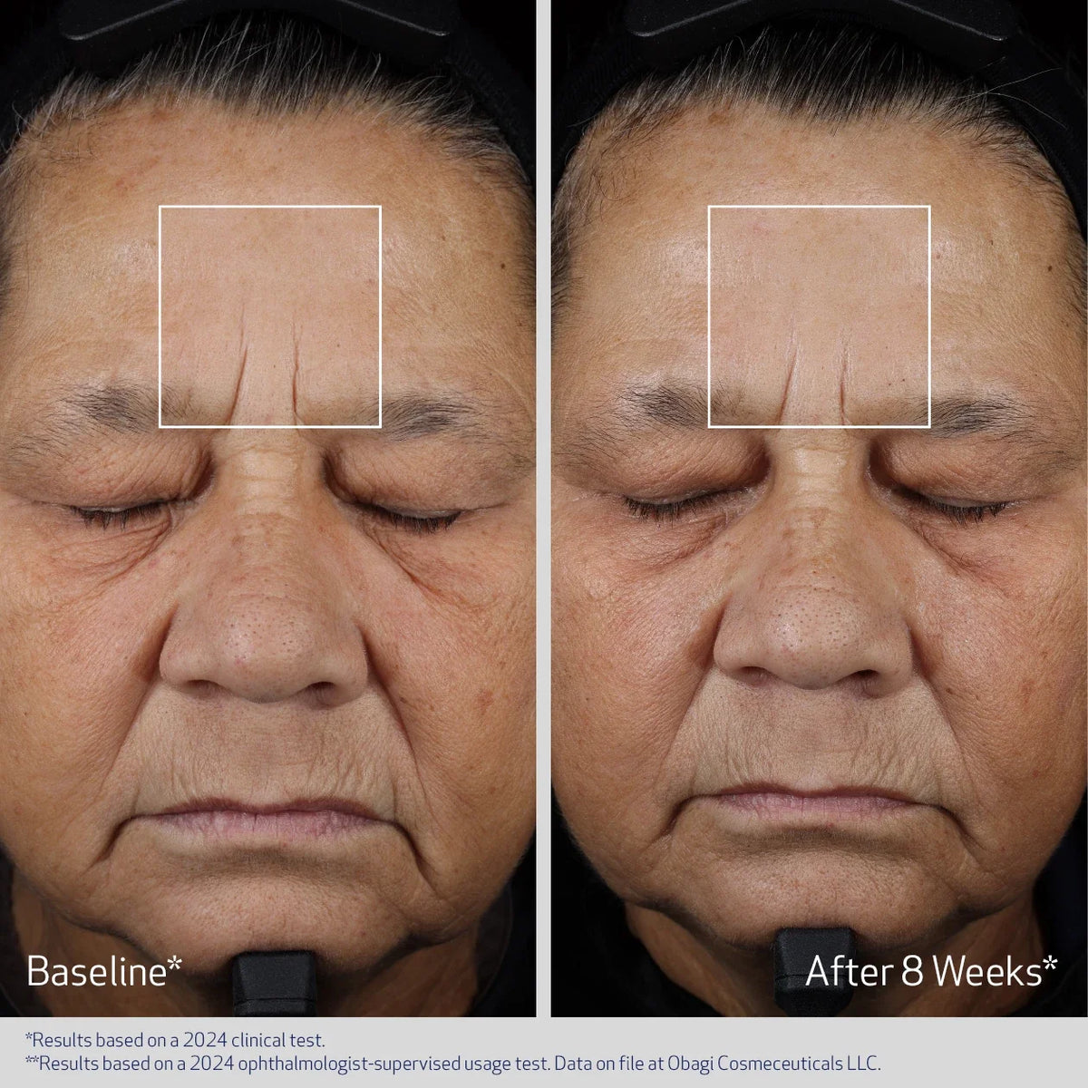 Obagi ELASTIderm® Advanced Filler Concentrate 20ml – before and after 2