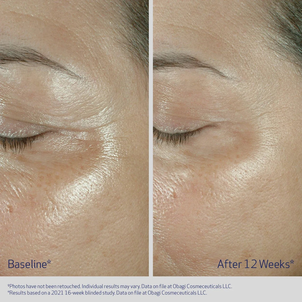 Obagi ELASTIderm® Firming Eye Cream 15g – before and after