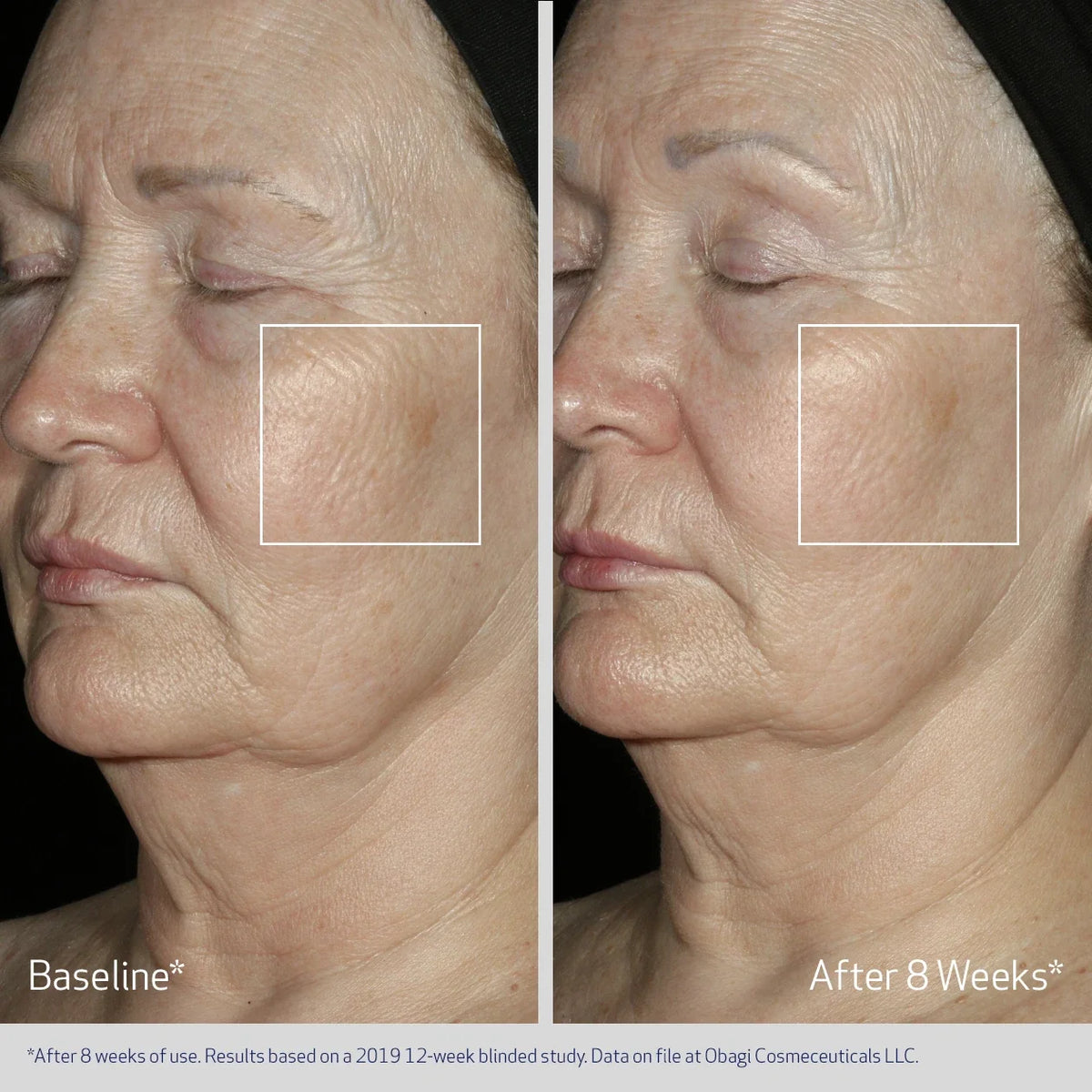 Obagi ELASTIderm® Facial Serum 30ml – before and after 2