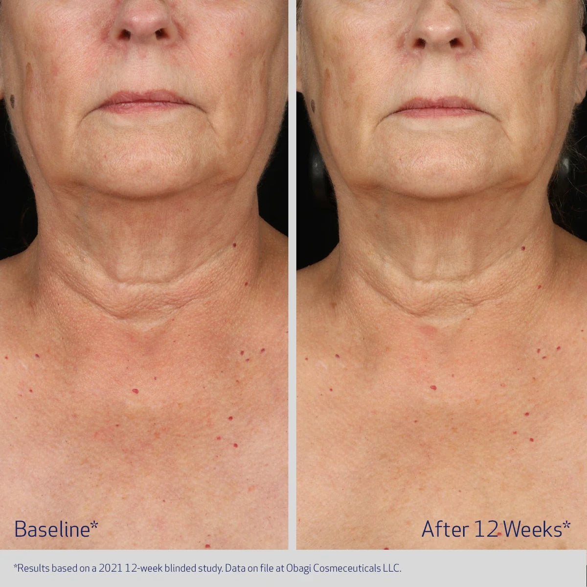 Obagi ELASTIderm® Neck & Décolleté Concentrate 60ml – before and after 2