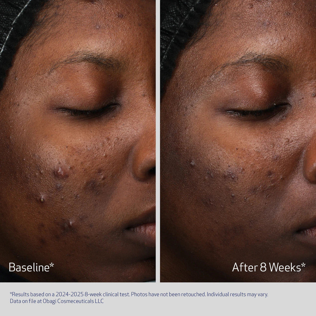 Obagi Retinol + PHA Refining Night Cream 50ml – before and after 2