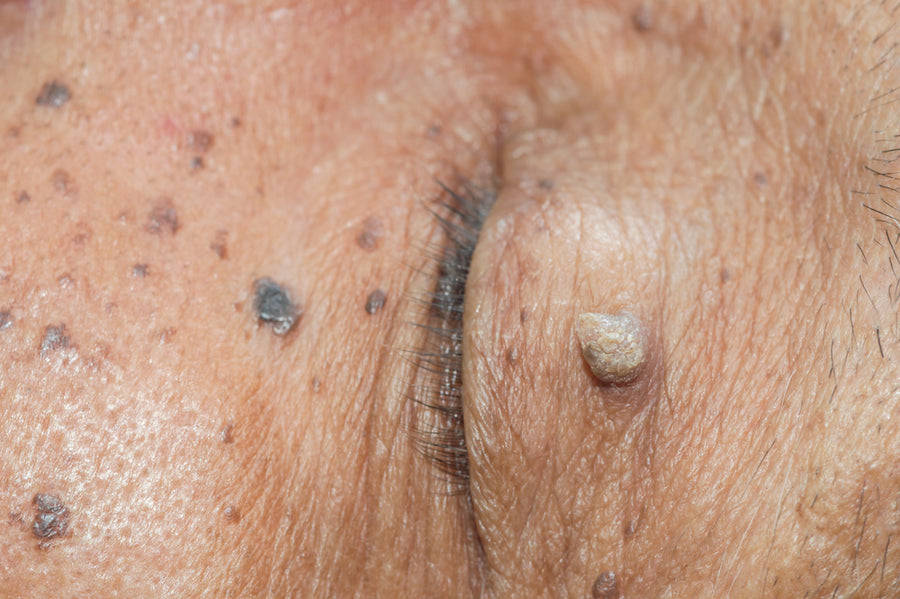 Cryosurgery Treatment at SkinVitál Clinic