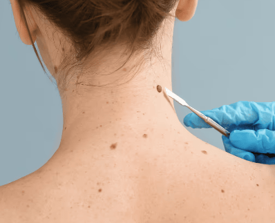 Skin Tag Treatments