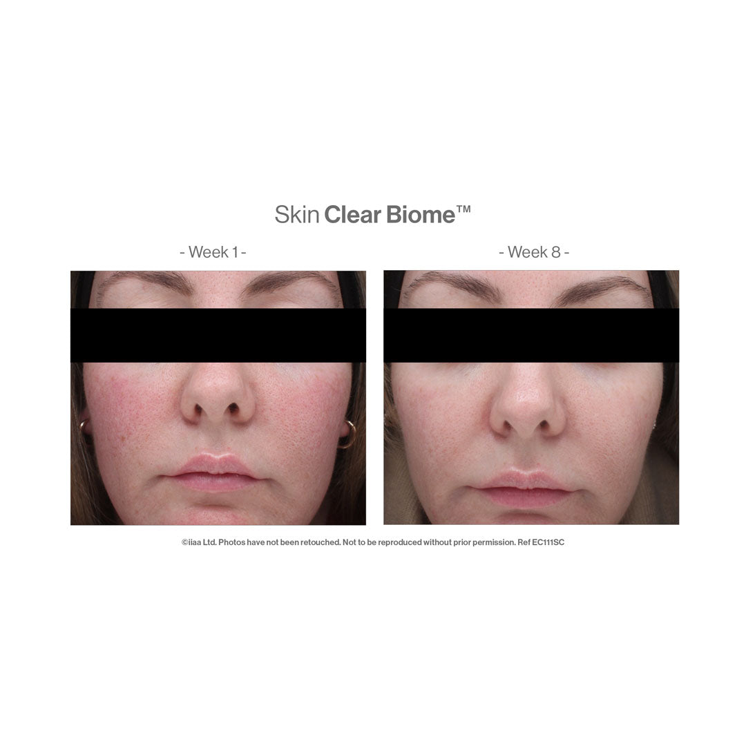 Advanced Nutrition Programme™ Skin Clear Biome™ – before and after (unretouched)