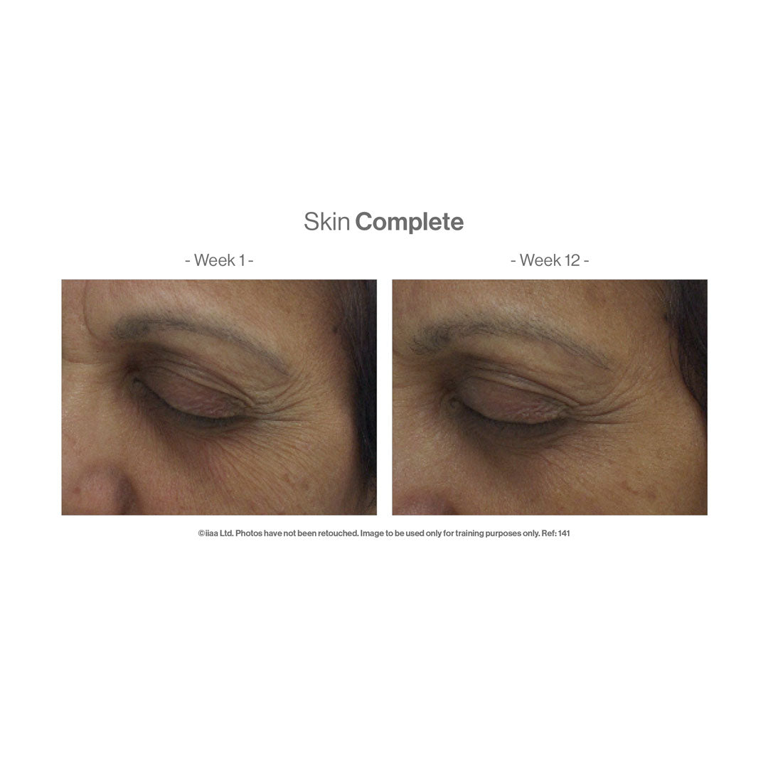 Advanced Nutrition Programme™ Skin Complete – before and after (unretouched)