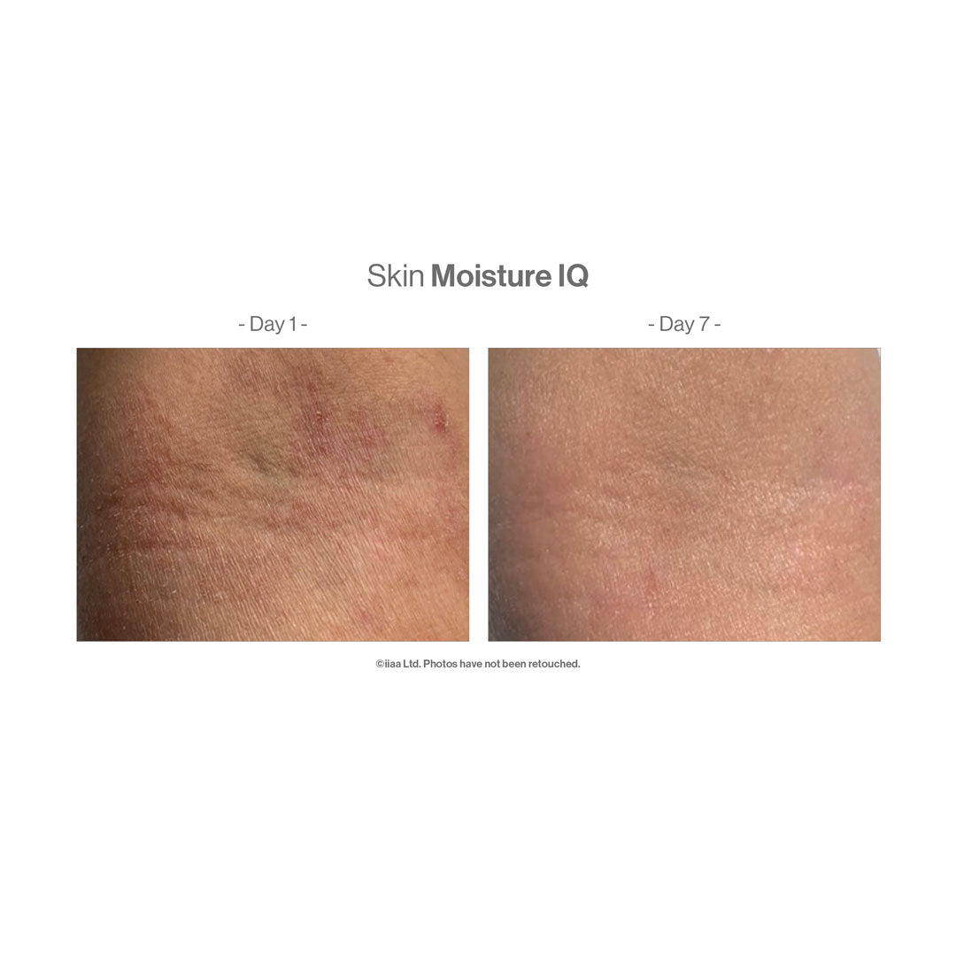 Advanced Nutrition Programme™ Skin Moisture IQ – before and after (unretouched)