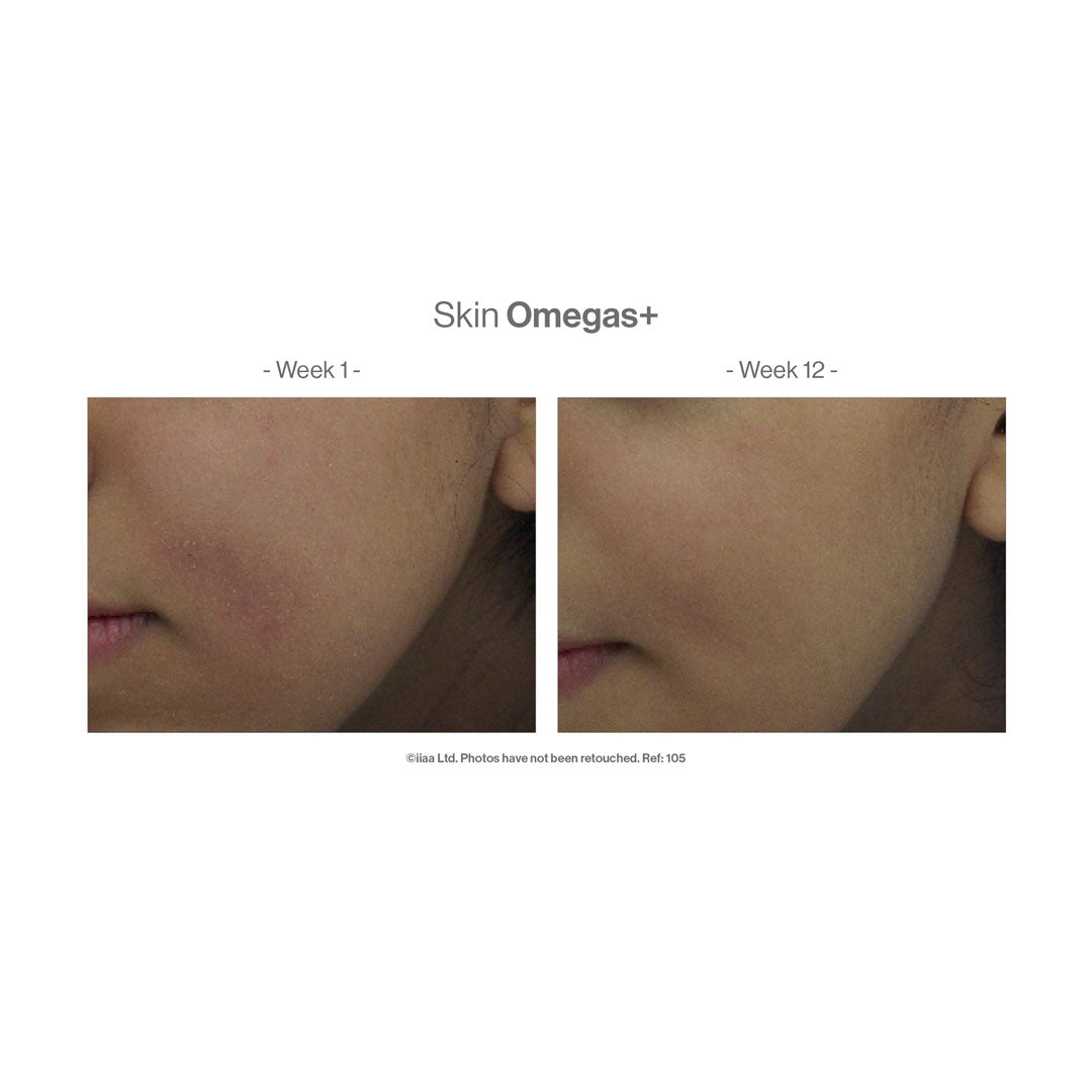 Advanced Nutrition Programme™ Skin Omegas+ – before and after (unretouched)