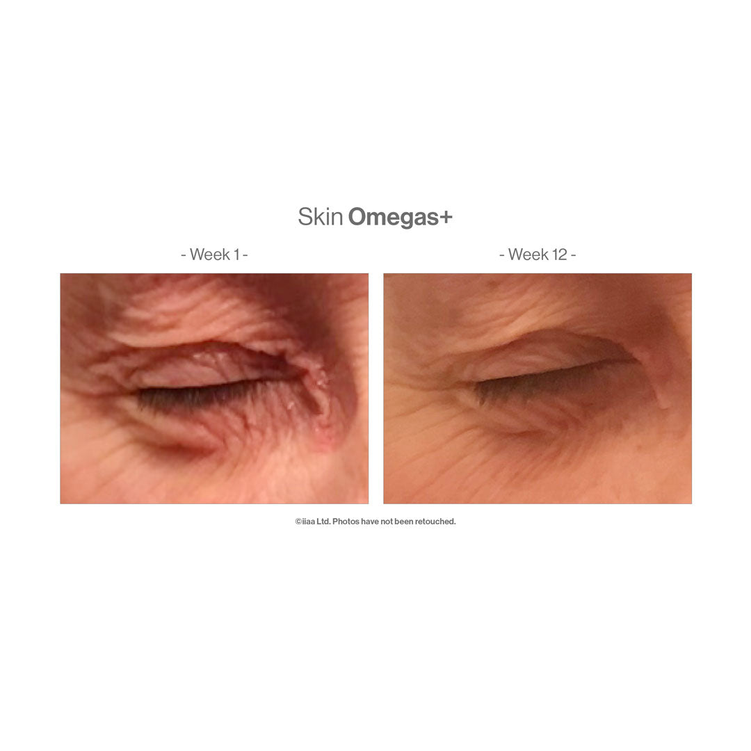 Advanced Nutrition Programme™ Skin Omegas+ – before and after (unretouched)