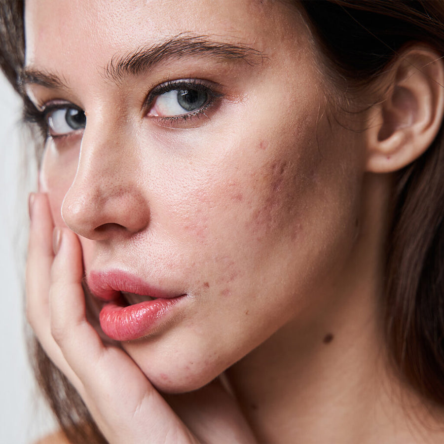 Acne Scar Treatment at SkinVitál Clinic
