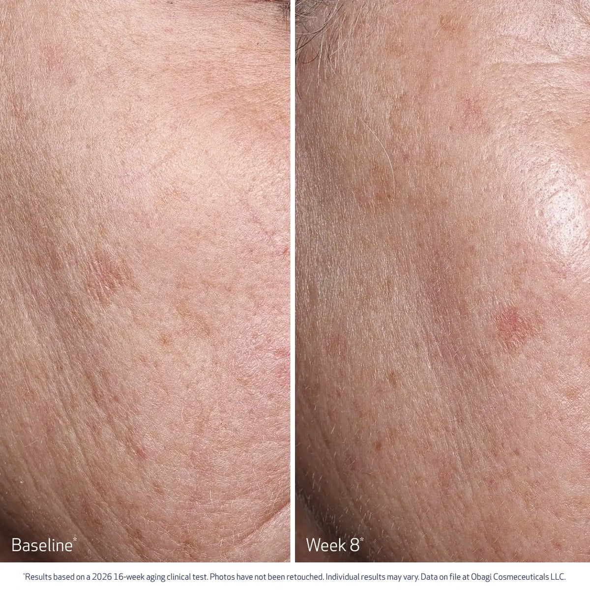Obagi Professional-C® Serum 20% 30ml – before and after