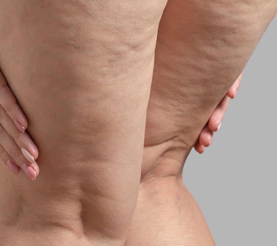 Cellulite Treatment at SkinVitál Clinic