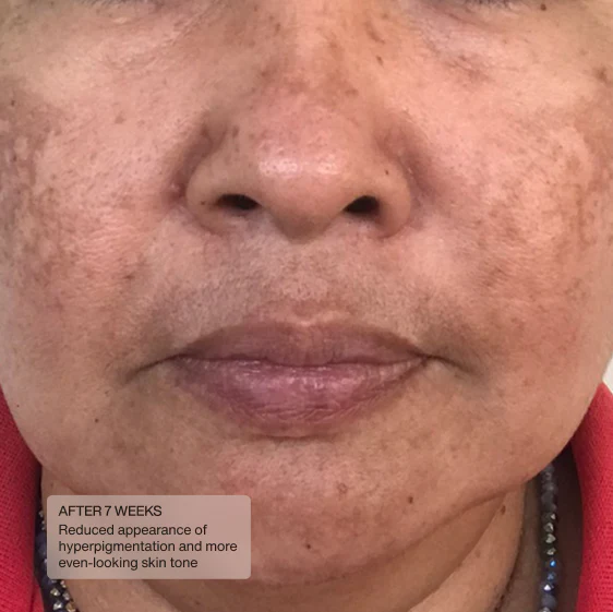 Senté Cysteamine HSA Pigment &amp; Tone Corrector