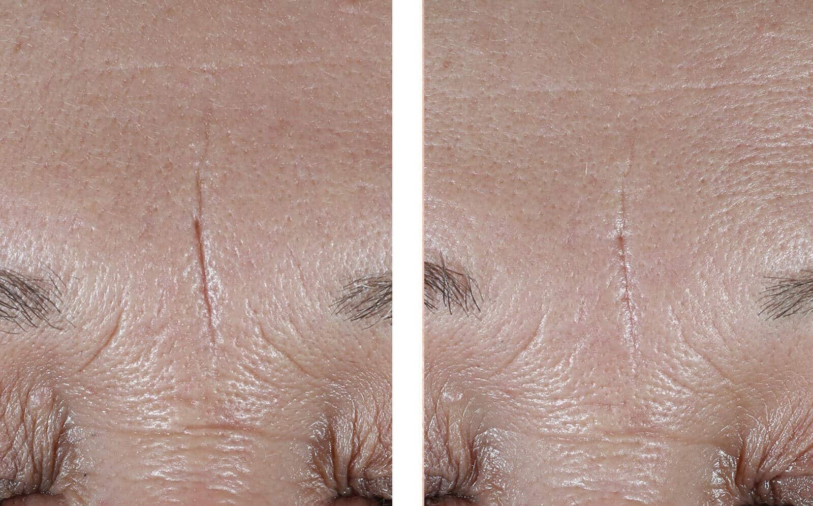 InterFuse® Treatment Cream FACE &amp; NECK, 30ml