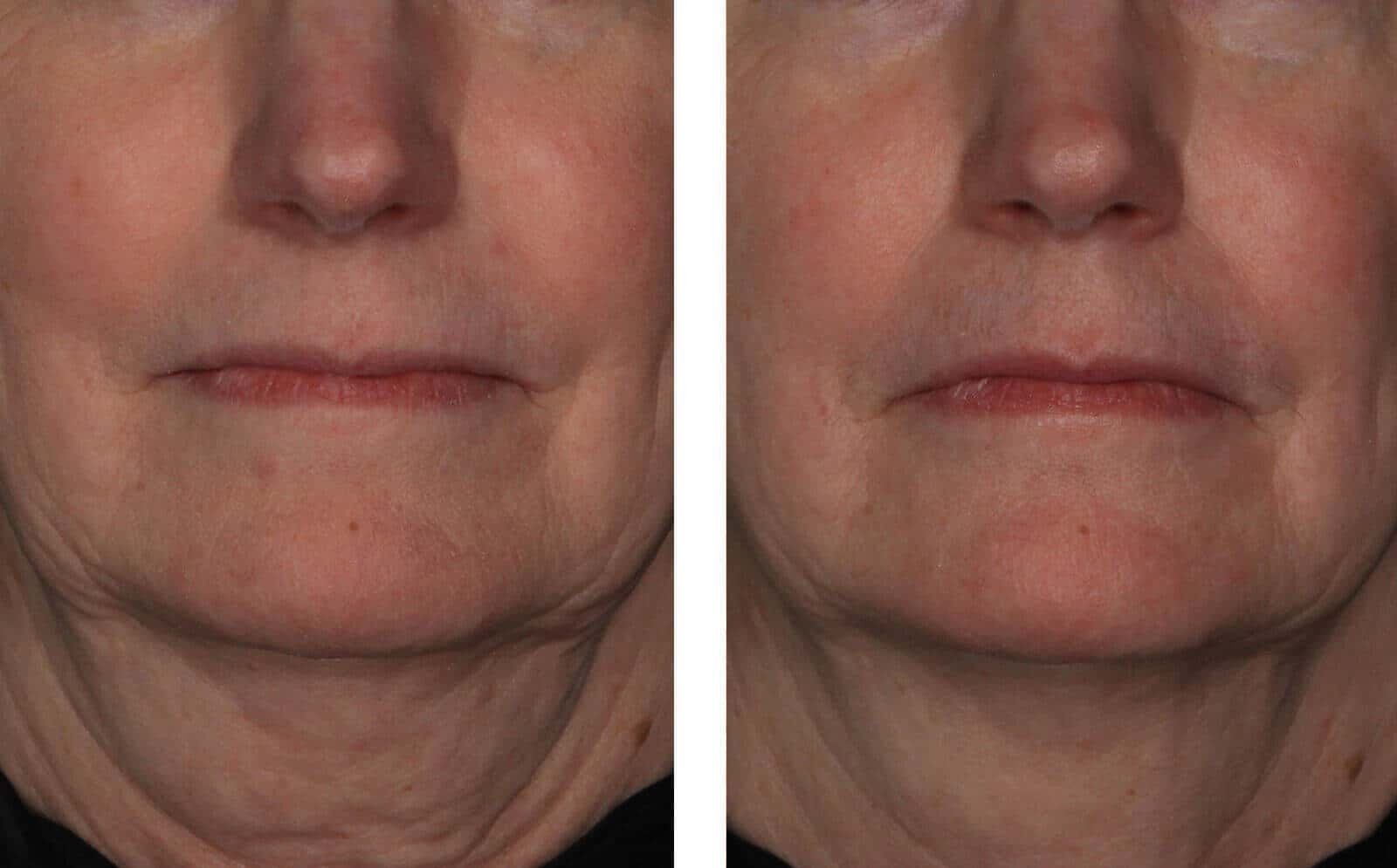 InterFuse® Treatment Cream FACE &amp; NECK, 30ml