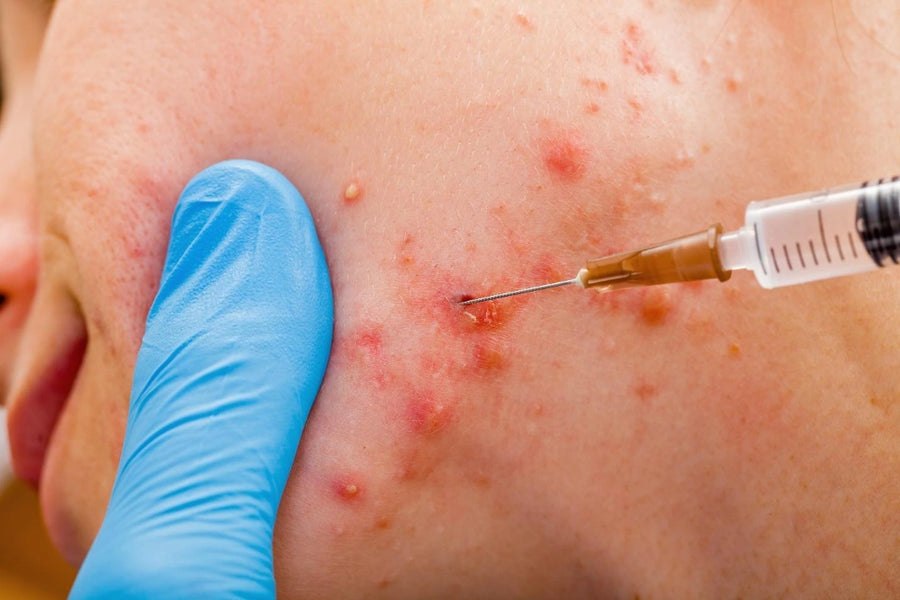 Intralesional Steroid Injections at SkinVitál Clinic