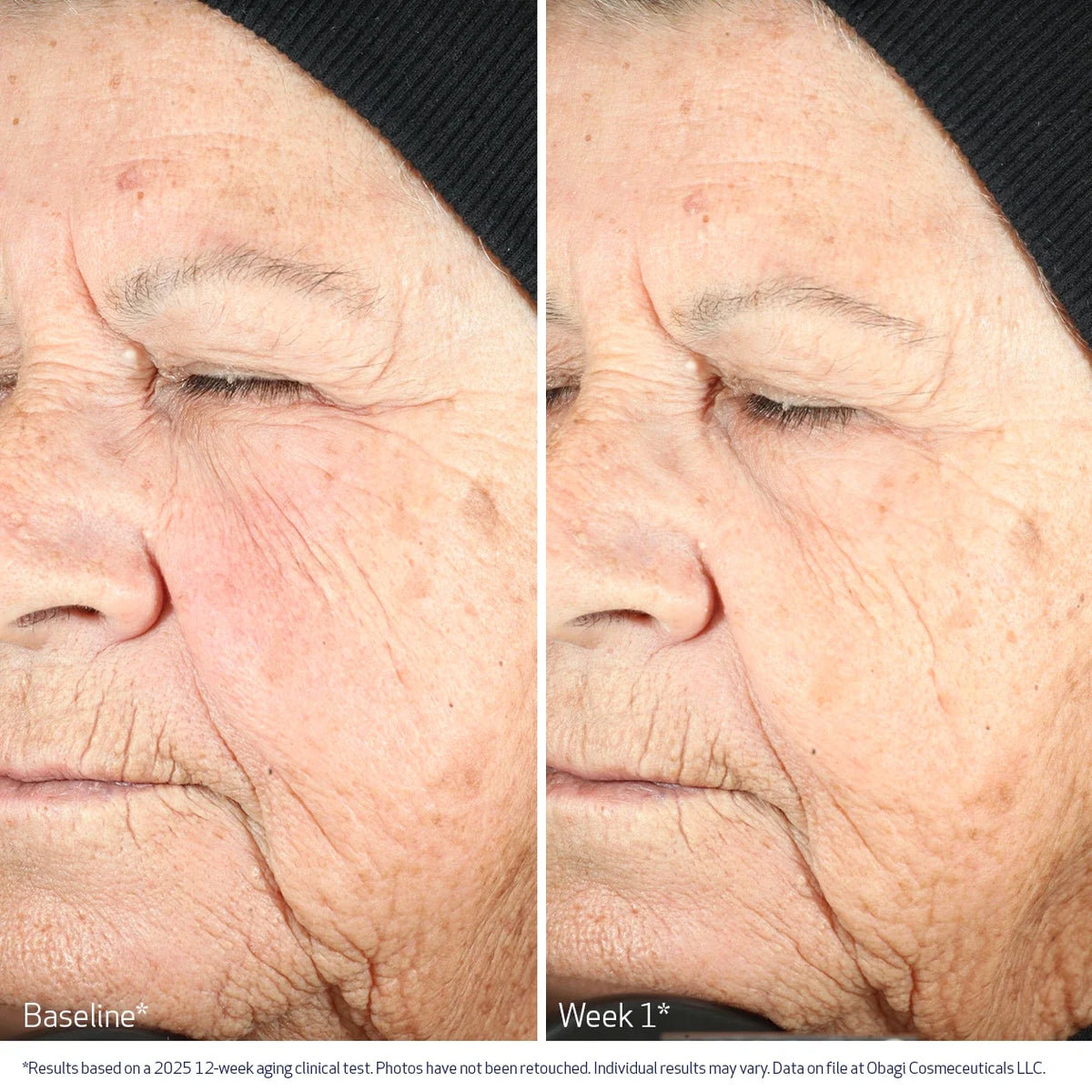 Obagi NU-GEN™ Cellular Renewal Serum 10ml – before and after 1