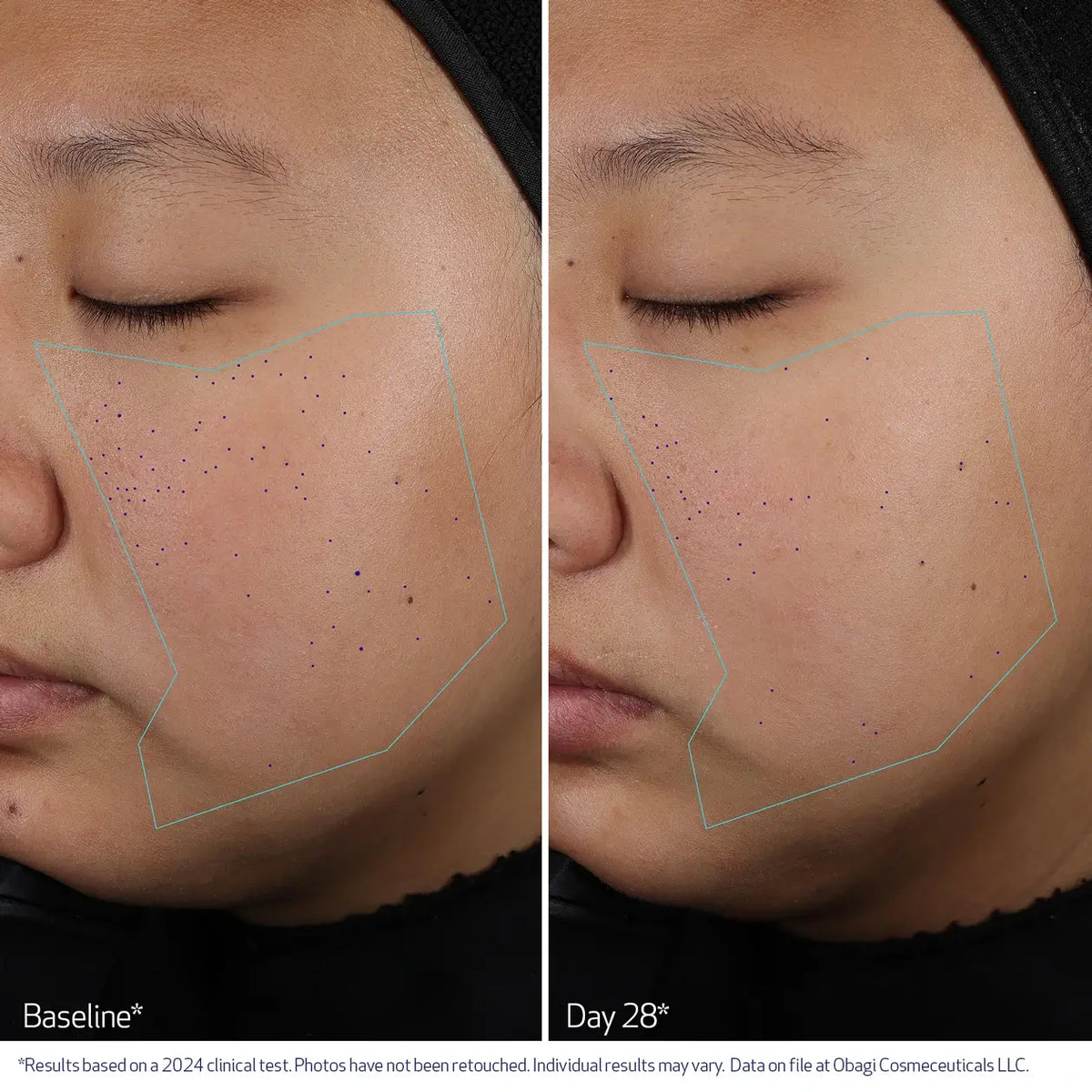 Obagi CLENZIderm M.D.® Pore Therapy 148ml – before and after 1