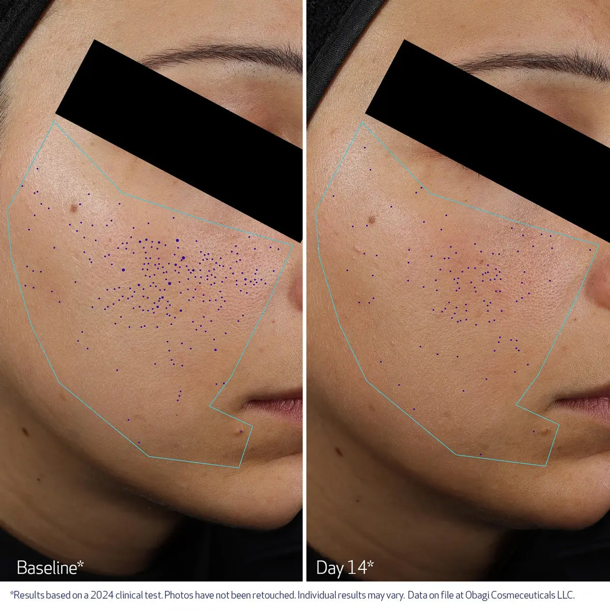 Obagi CLENZIderm M.D.® Pore Therapy 148ml – before and after 2