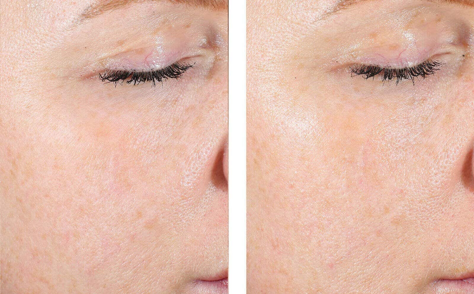 AlphaRet® Exfoliating Peel Pads, 30 pads