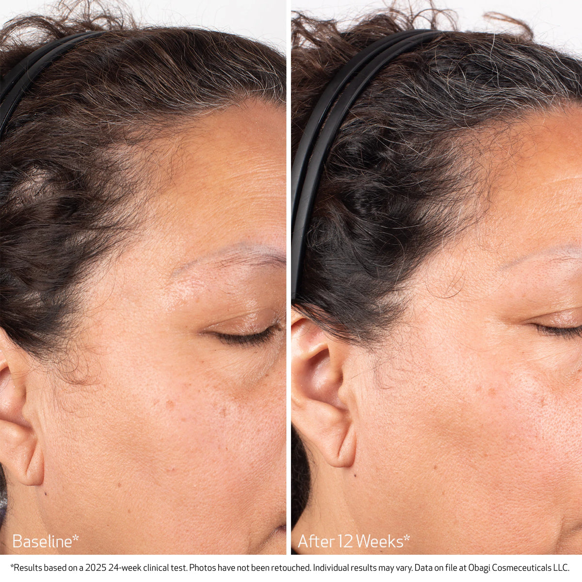 Obagi NU-CIL BIOSTIM™ Scalp Serum 60ml – before and after 1