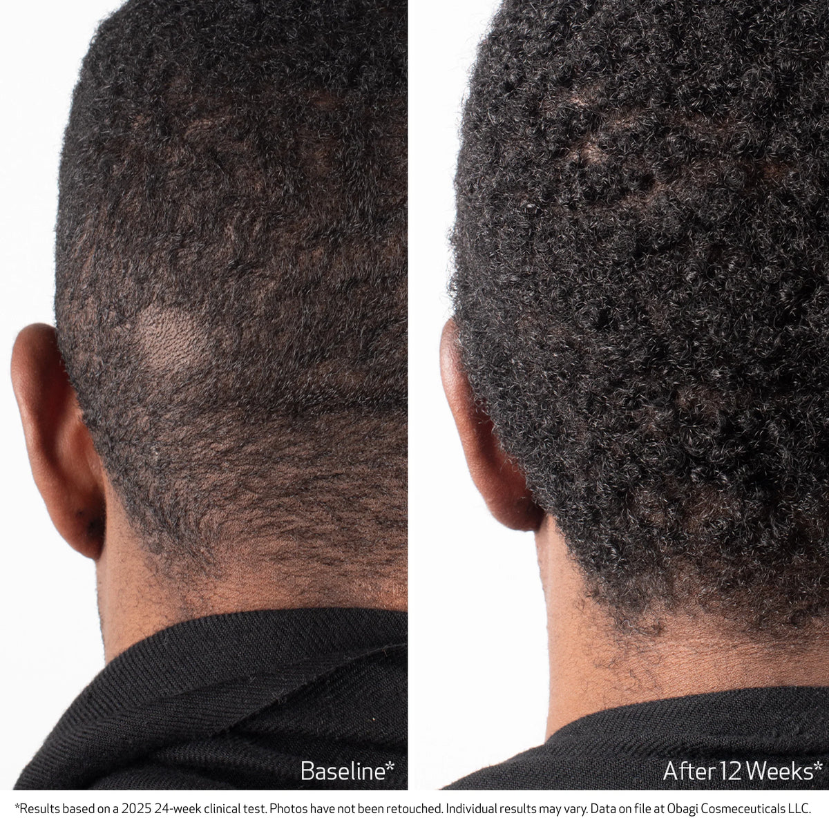 Obagi NU-CIL BIOSTIM™ Scalp Serum 60ml – before and after 2