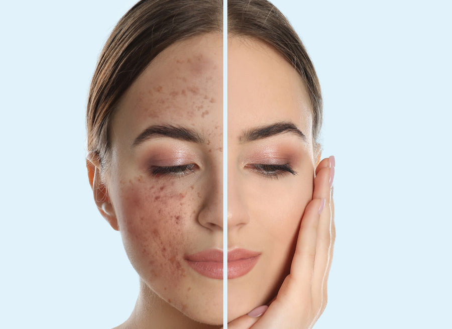 Cosmelan Peel at SkinVitál Clinic