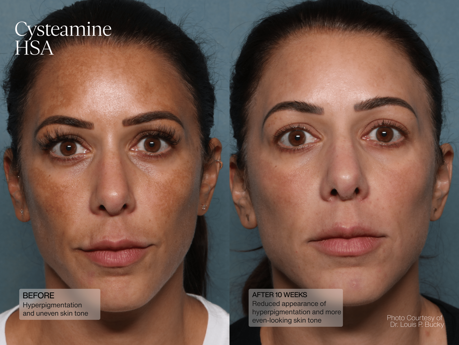 Senté Cysteamine HSA Pigment &amp; Tone Corrector