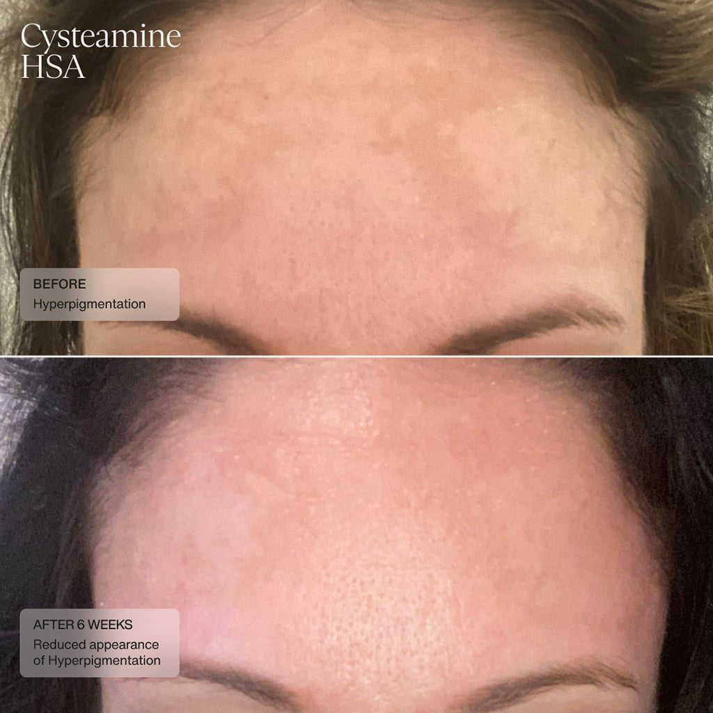 Senté Cysteamine HSA Pigment &amp; Tone Corrector