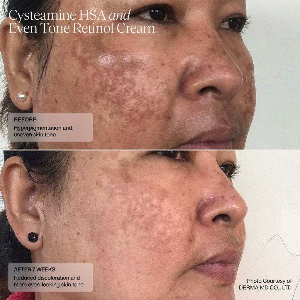 Senté Cysteamine HSA Pigment &amp; Tone Corrector