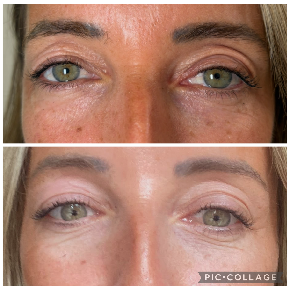 Before and after treatment at SkinVital Clinic