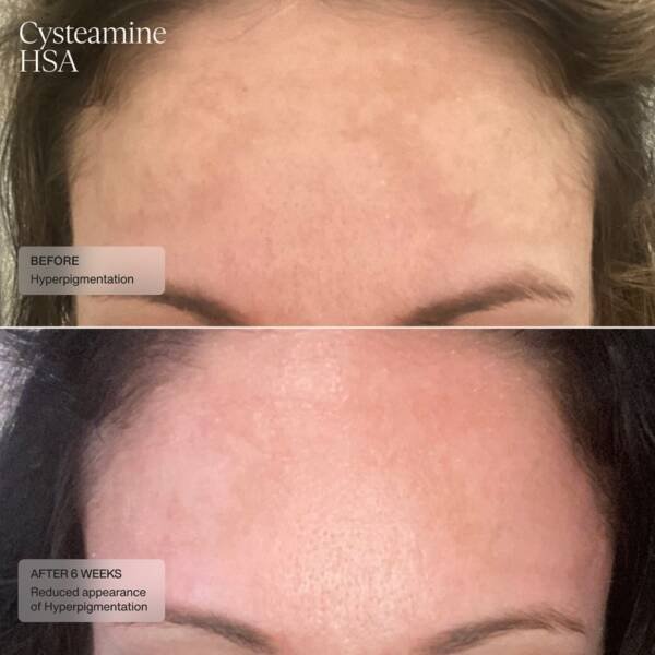 Senté Cysteamine HSA Pigment & Tone Corrector - Image 7