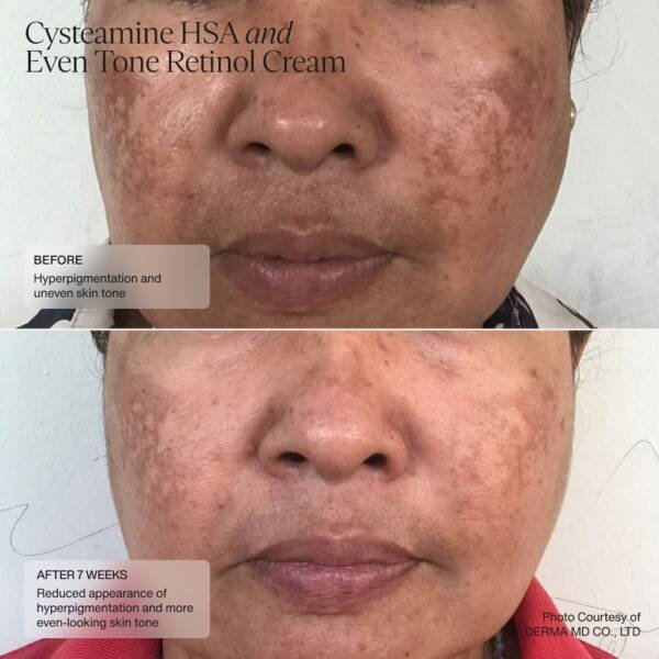 Senté Cysteamine HSA Pigment & Tone Corrector - Image 5